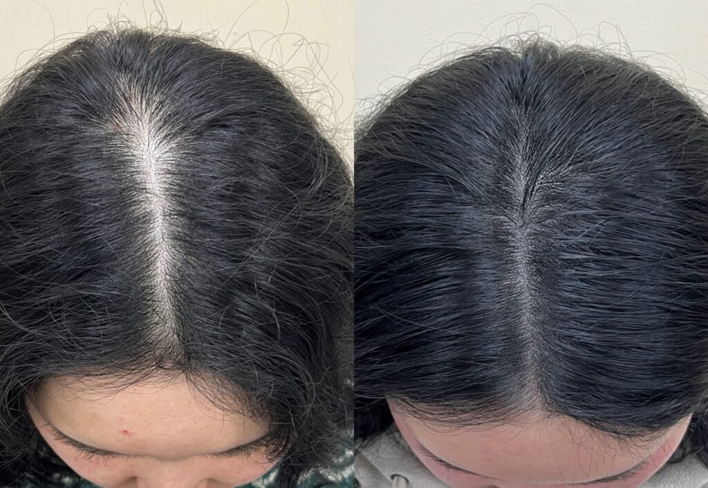 여성 가르마가 넓어진 부위의 두피문신 전후 비교