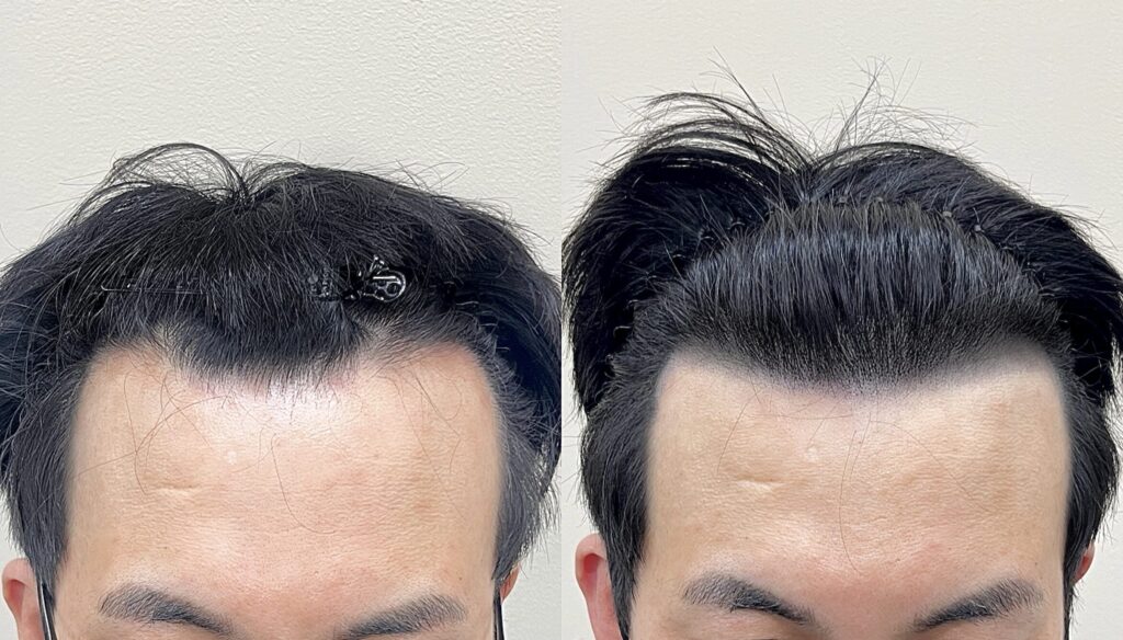 남성 M자 헤어라인 탈모두피문신 전후 정면 비교