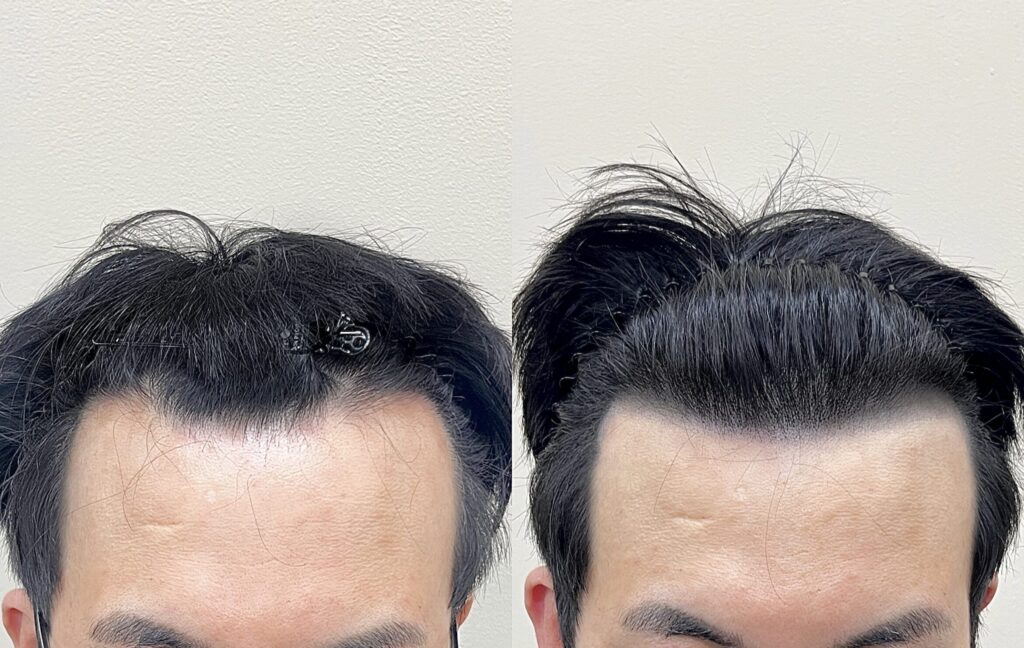 M자탈모 상담 후 진행한 헤어라인 두피문신 전후 정면 비교