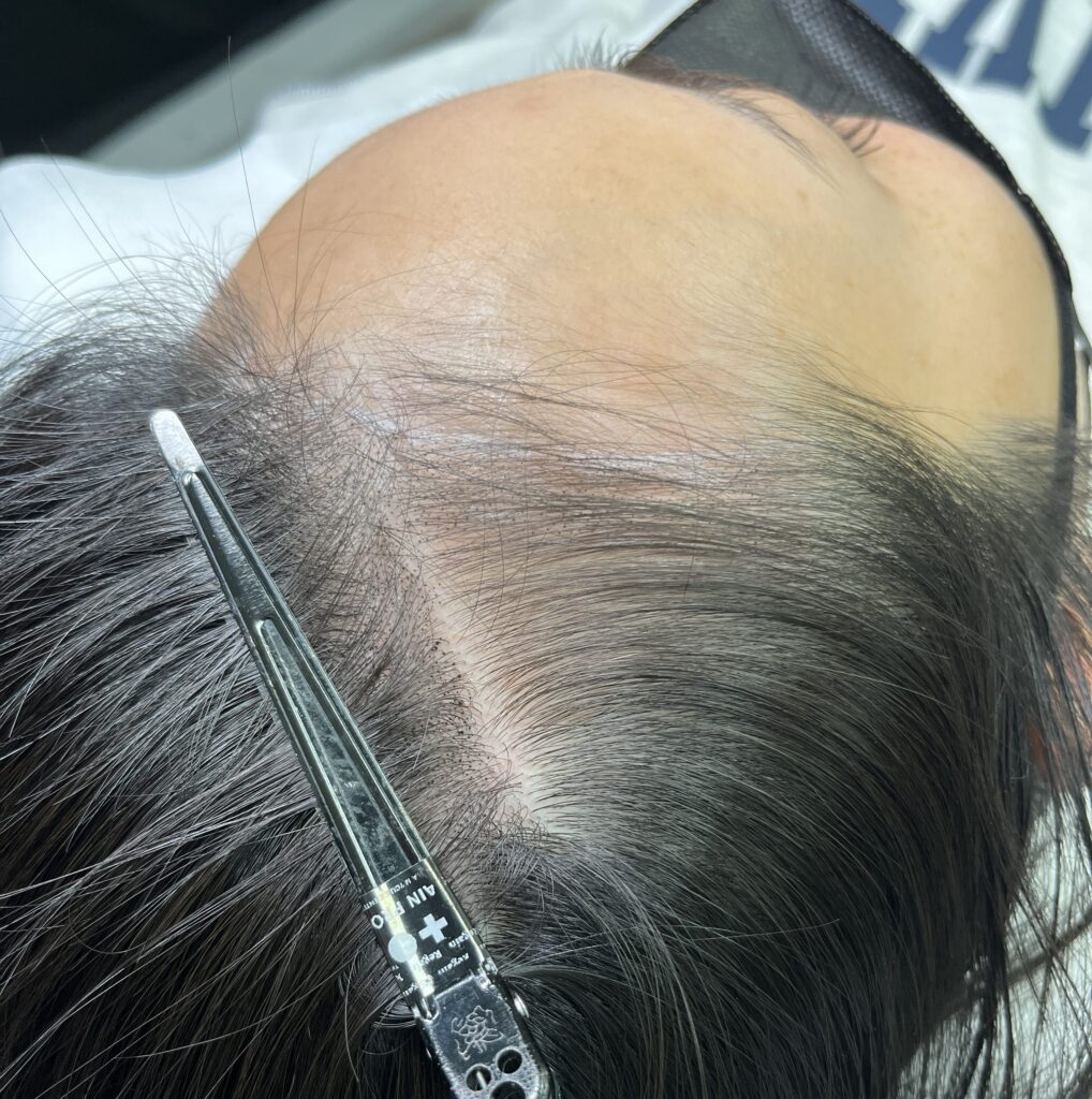 가르마 주변 두피가 비쳐 보이는 시술 전 상태