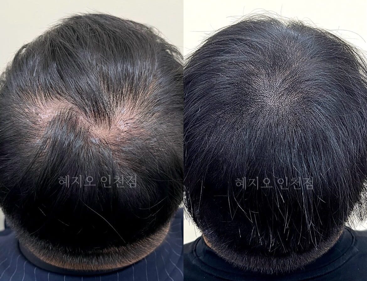 남성 정수리 밀도를 채운 두피문신 전후