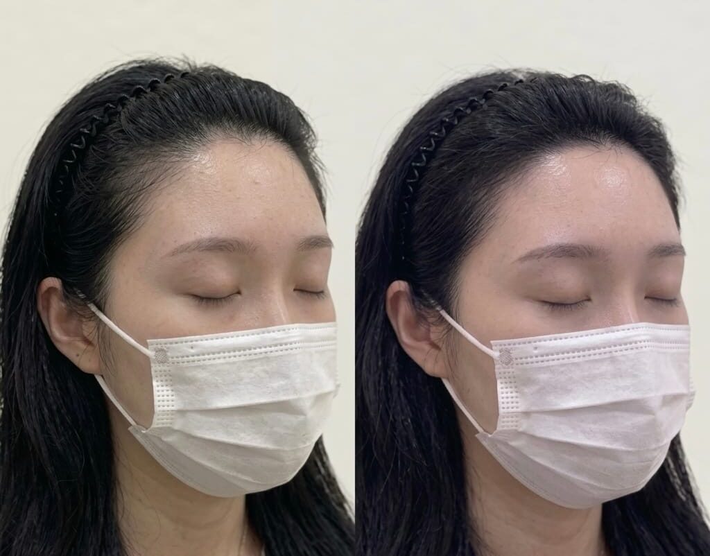여성 헤어라인 두피문신 전후 45도 측면 비교, 옆 이마 라인의 변화