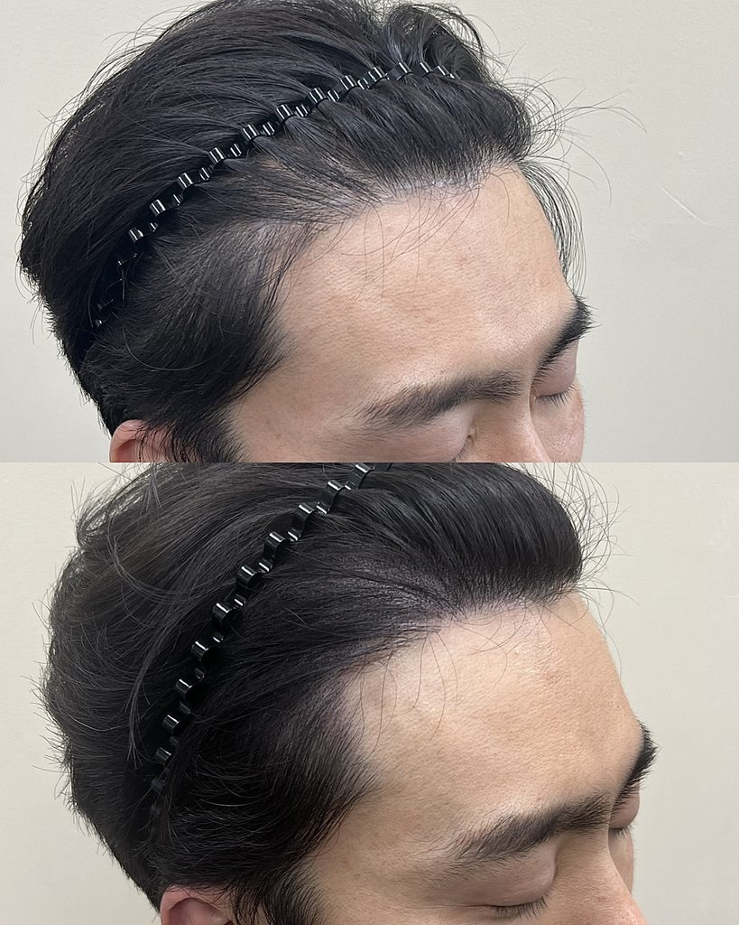 후퇴한 M자 헤어라인 두피문신 전후 비교, 위에서 본 옆 이마 경계의 변화