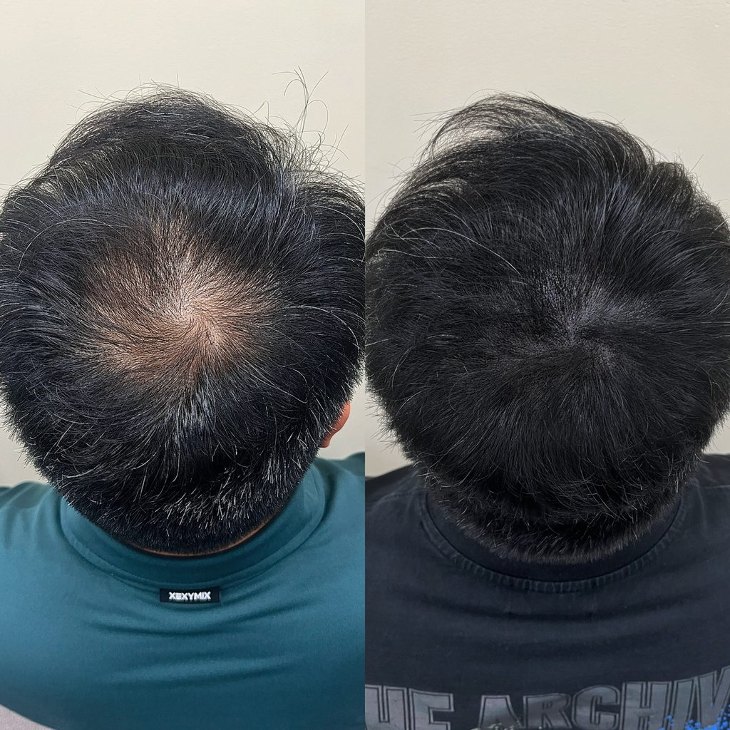 50대 남자 정수리 두피문신 비포애프터, 가마 주변 두피 노출이 줄어든 비교 사진