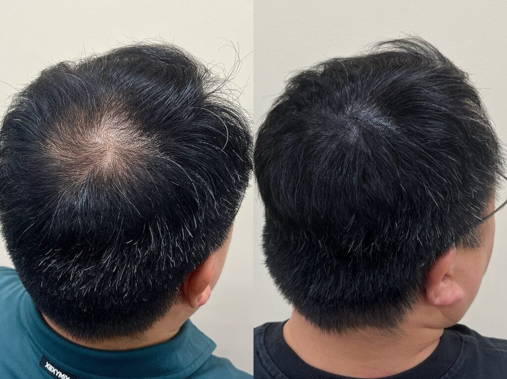 회차를 나눠 채운 정수리 전후 비교