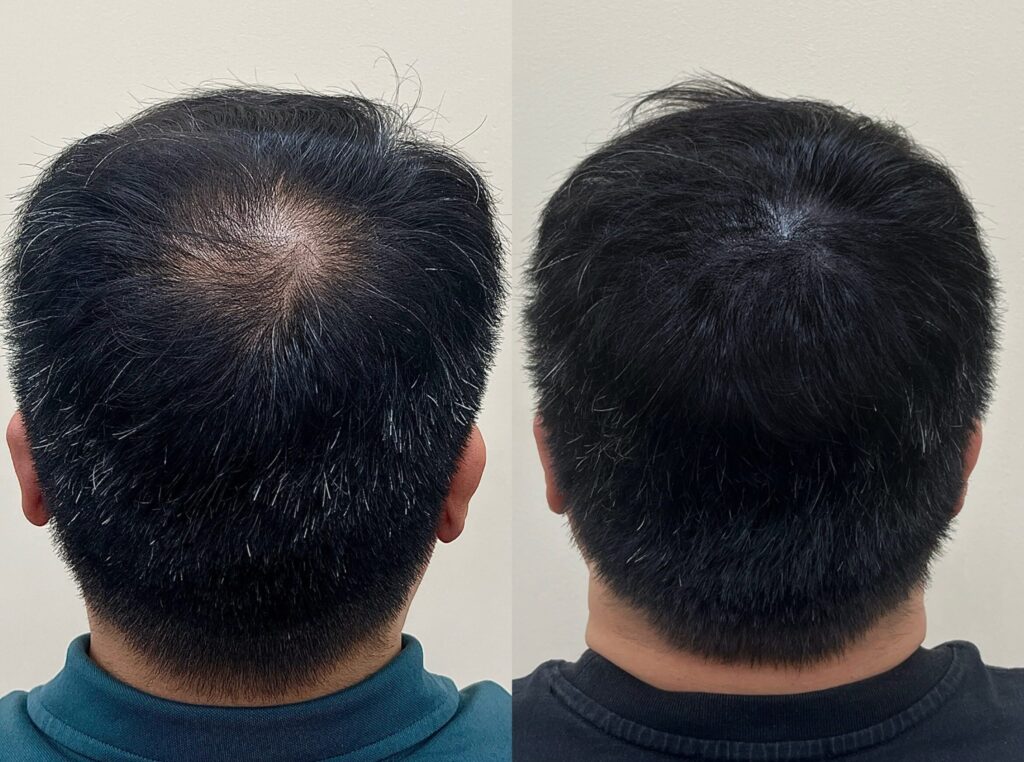 남성 뒤통수 정수리 두피문신 전후 비교