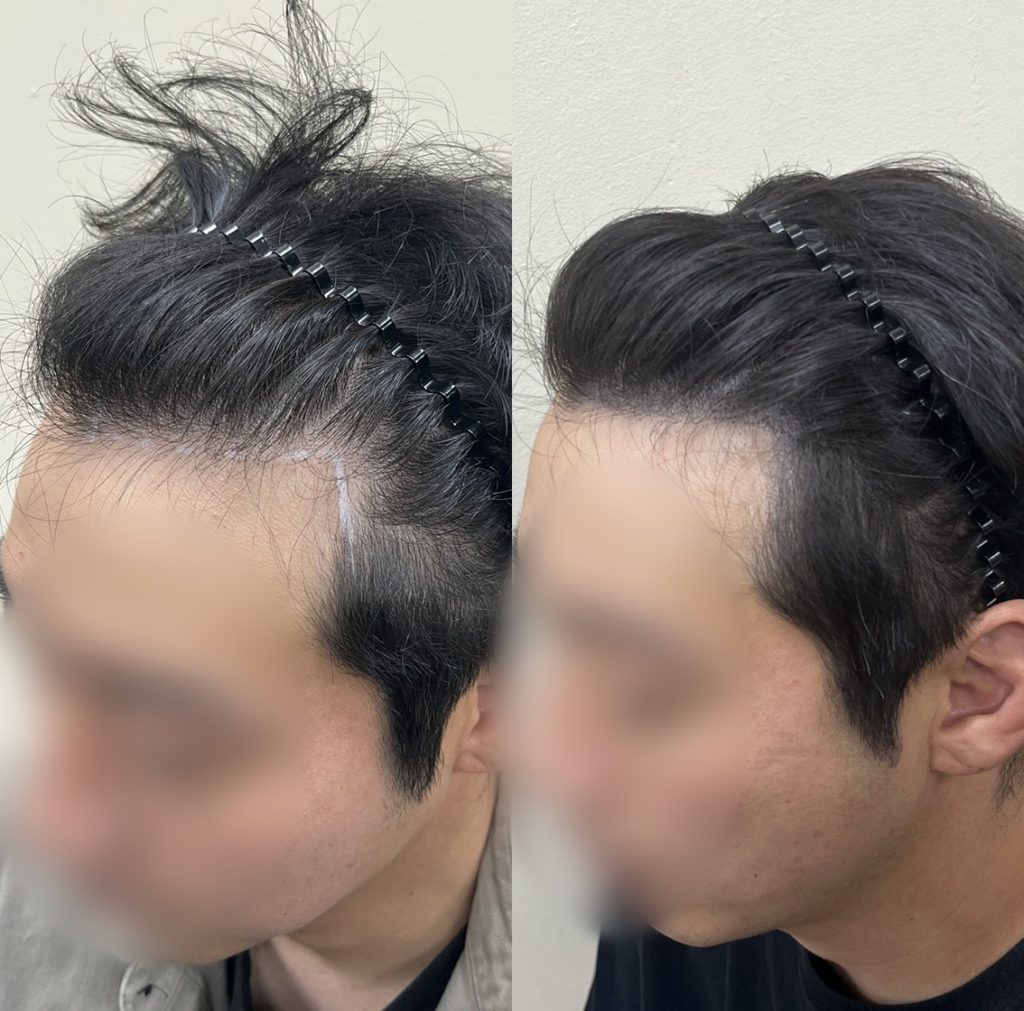 관자놀이 쪽 M자 헤어라인 두피문신 전후 측면 비교, 각이 깊던 옆 라인이 채워진 모습
