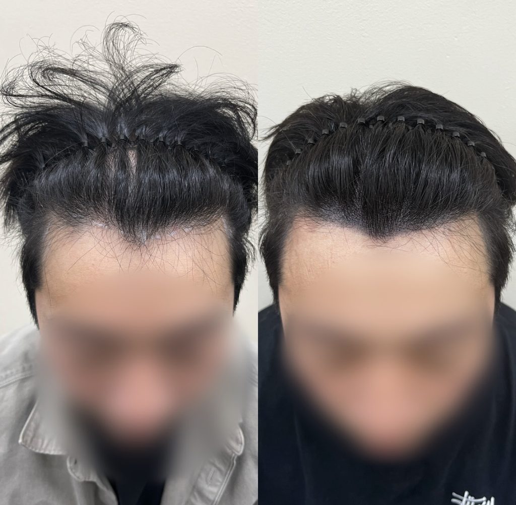 M자탈모 남성 헤어라인 두피문신 전후 정면 비교 - 시술 전 양쪽 각이 깊게 파인 M자 라인과 시술 후 도트로 채워 자연스러워진 앞머리 경계