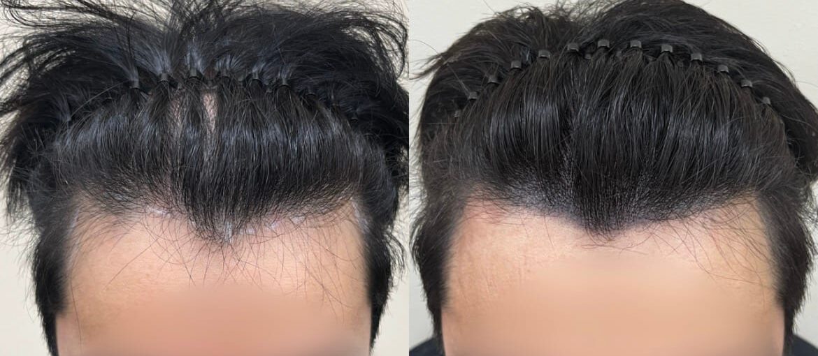 남성 헤어라인 두피문신 전후 정면 비교