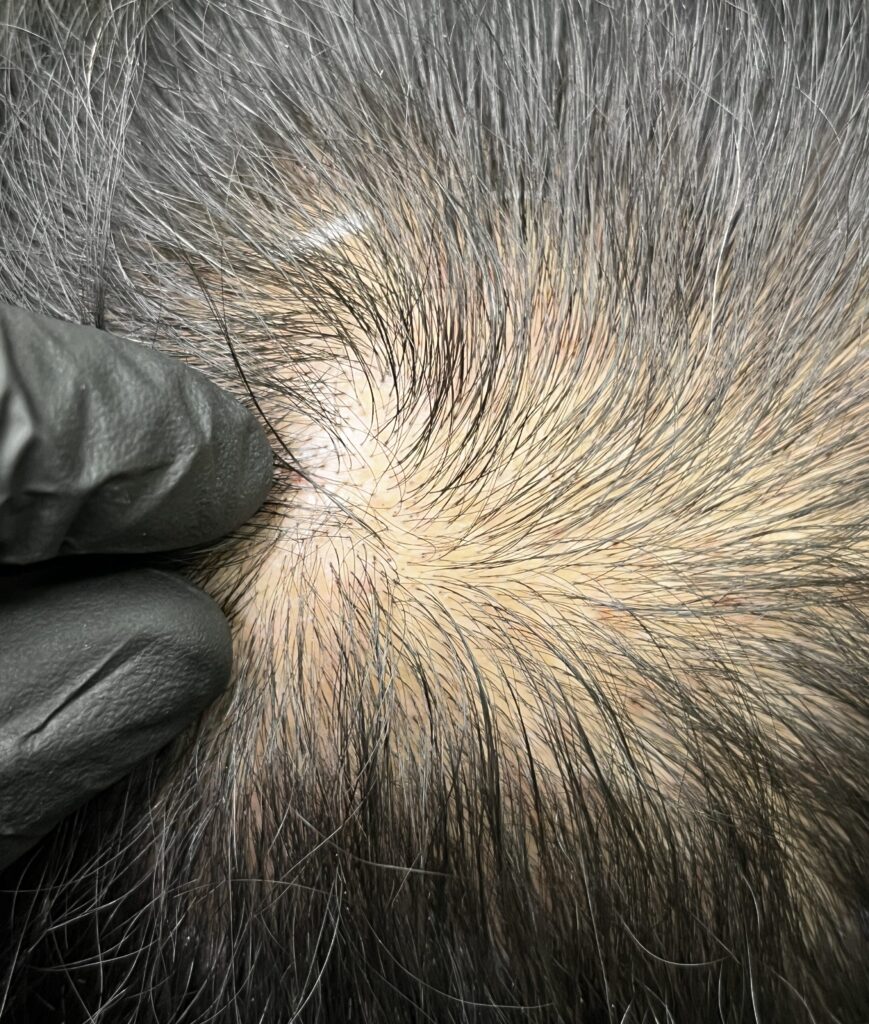 장갑 낀 손으로 벌려 확인한 정수리 가마 근접 사진, 흰머리가 섞인 두피 상태