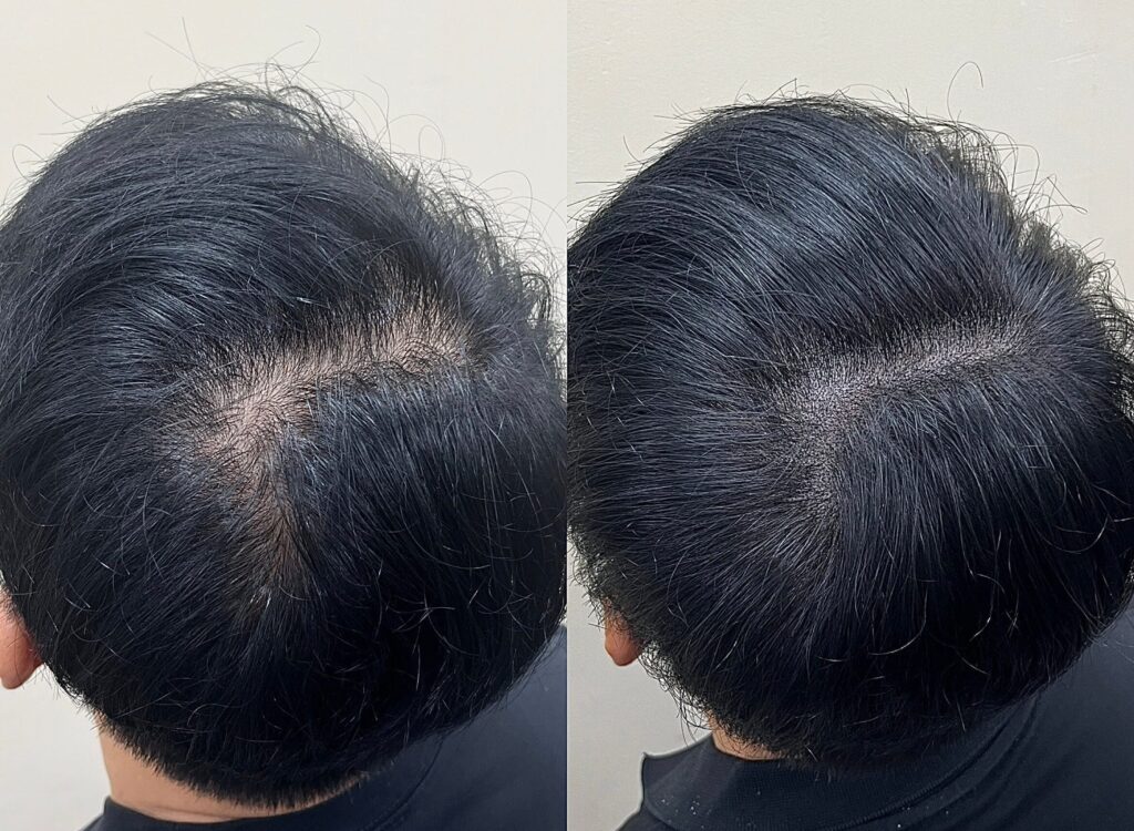 남성 정수리 두피문신 전후 측면 비교