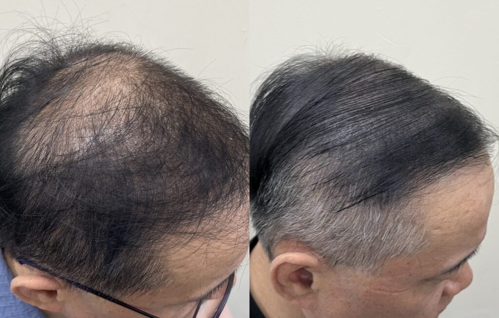 남성 정수리 두피문신 전후 측면 비교, 앞쪽까지 이어진 밀도 변화