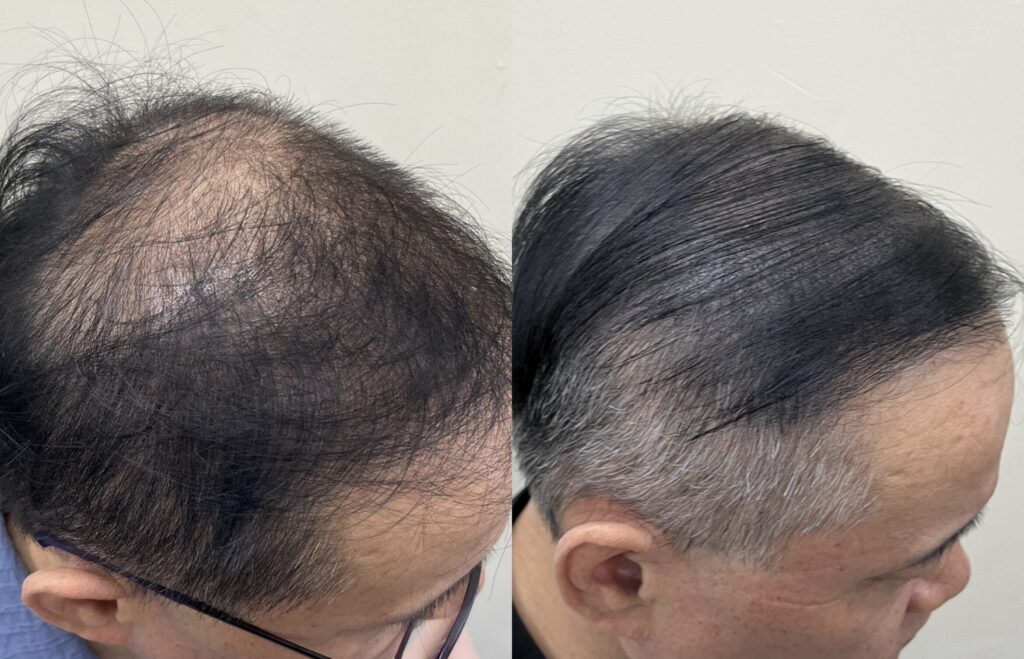 흰머리가 섞인 남성 정수리·M자 부위 두피문신 전후 측면 비교