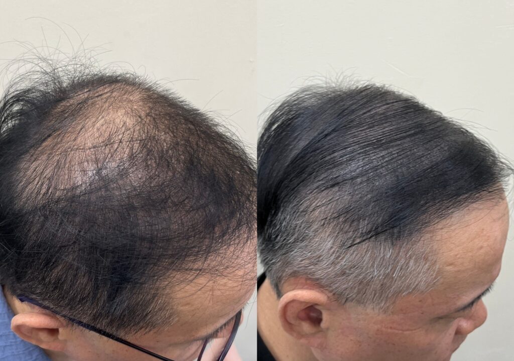 흰머리가 섞인 옆쪽 헤어라인의 시술 전후 비교