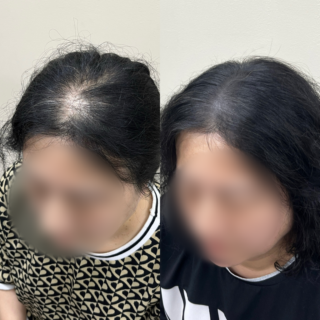 여자정수리 두피문신 시술 전후 비교, 비어 보이던 정수리가 채워진 모습
