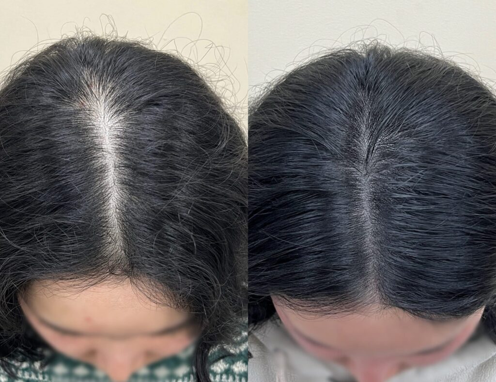 회차를 거치며 좁아 보이게 정리된 가르마 라인 비교