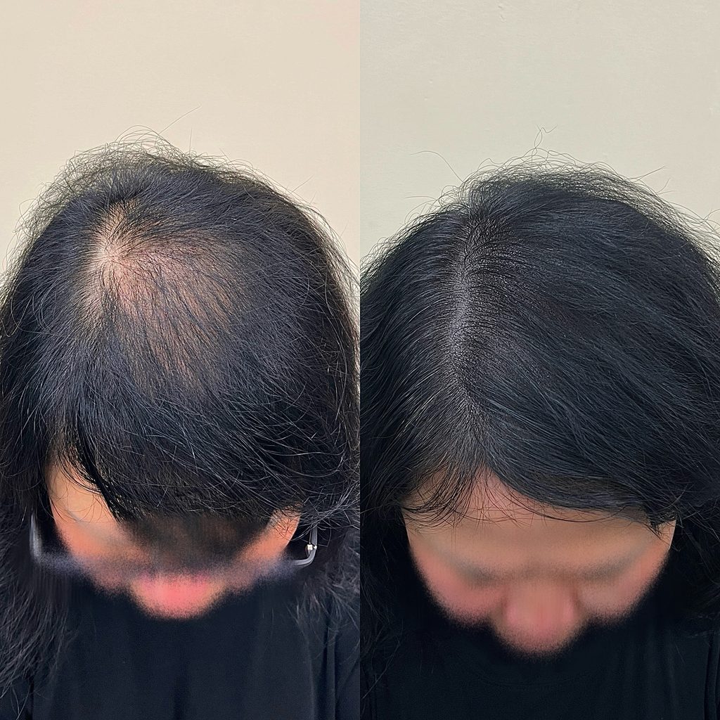 여자정수리 두피문신 4회차 시술 전후 비교, 앞쪽 헤어라인에서 본 정수리 밀도 변화