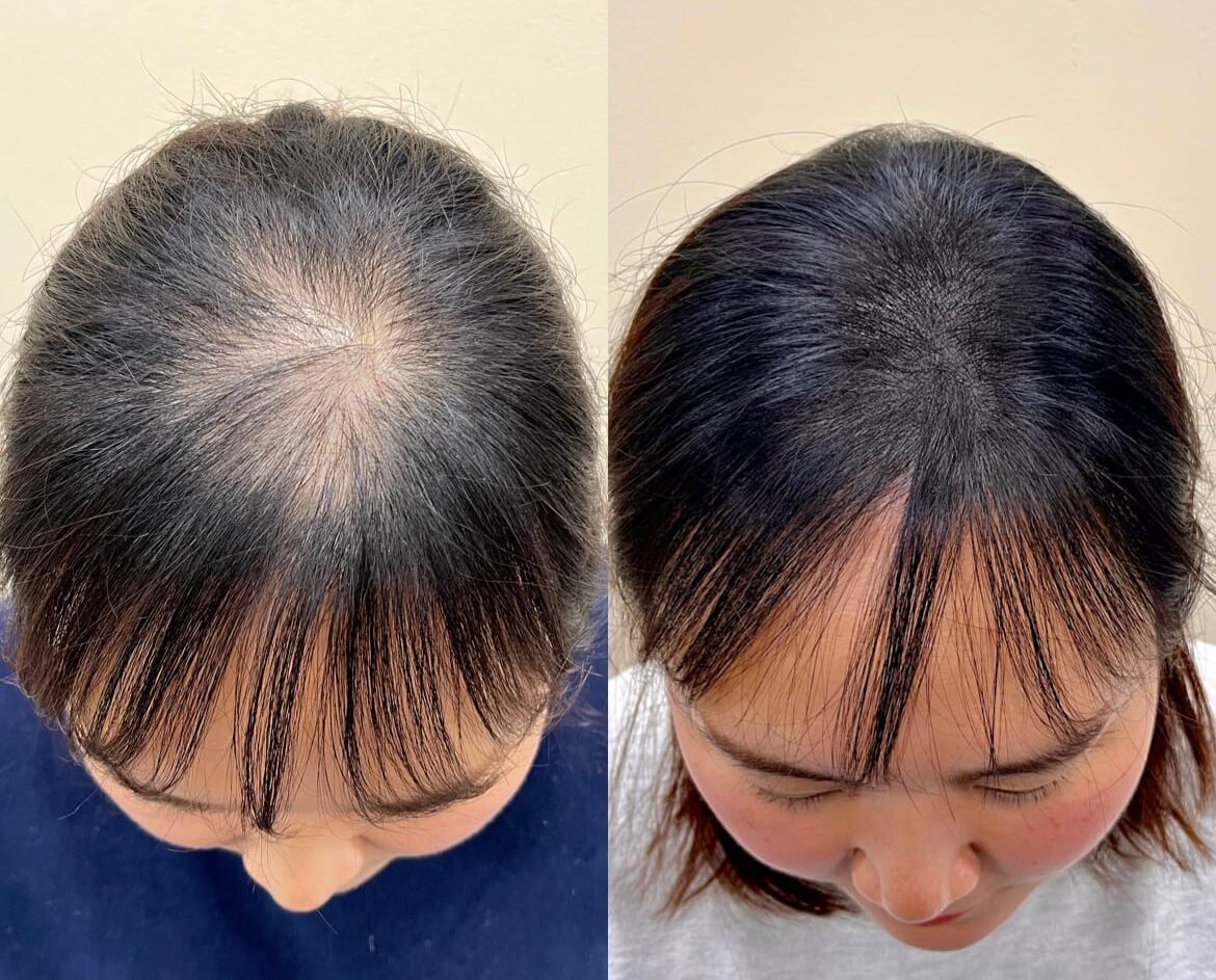 부위마다 필요한 회차가 다른 정수리·가르마 전후 비교