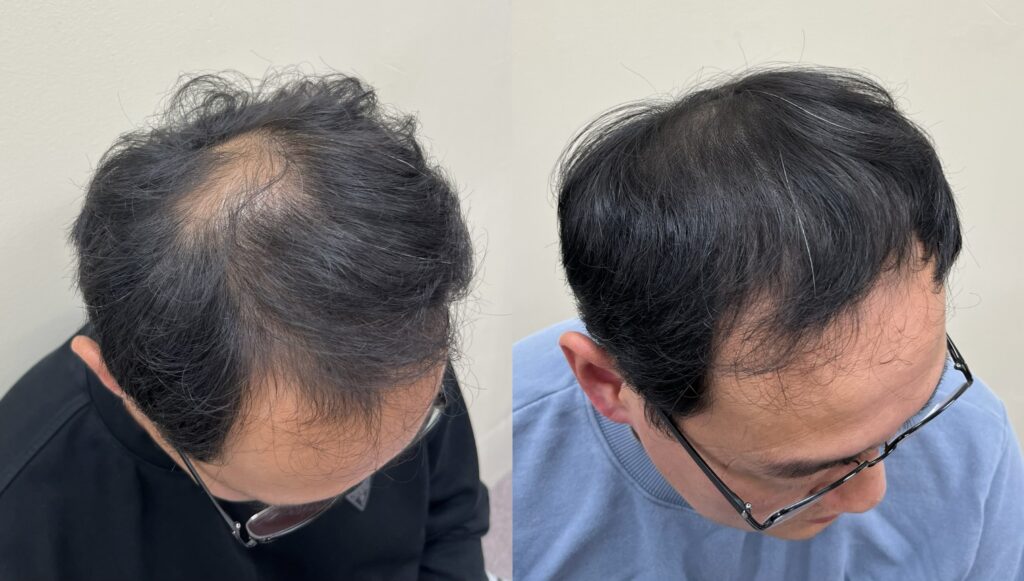 남자정수리탈모 두피문신 전후 비교, 가마 주변 두피가 드러나던 부위가 채워진 모습