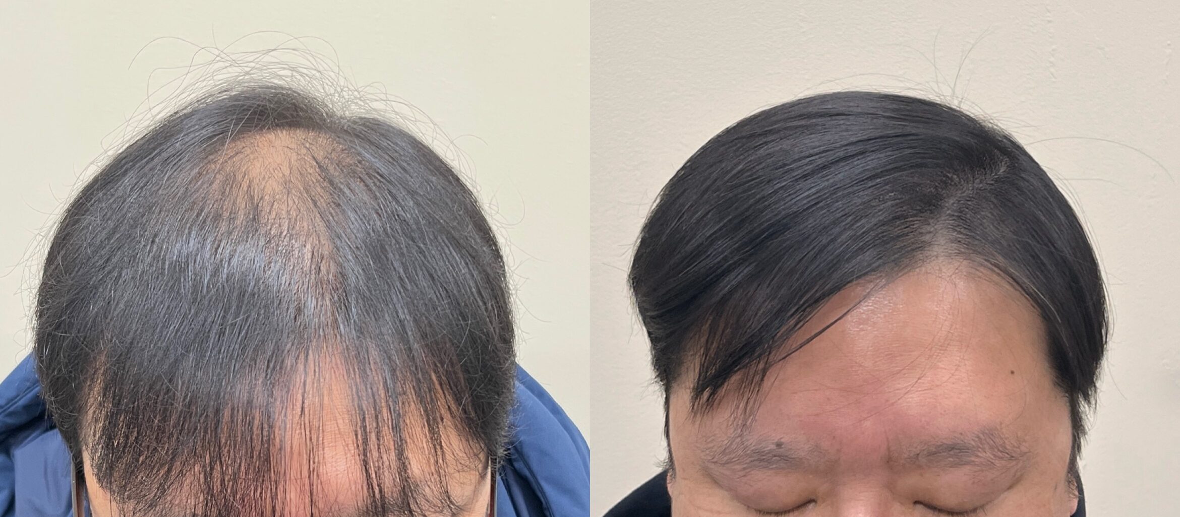 앞머리로 덮어 가리던 헤어라인이 두피문신 뒤 달라진 50대 남성 비교 사진