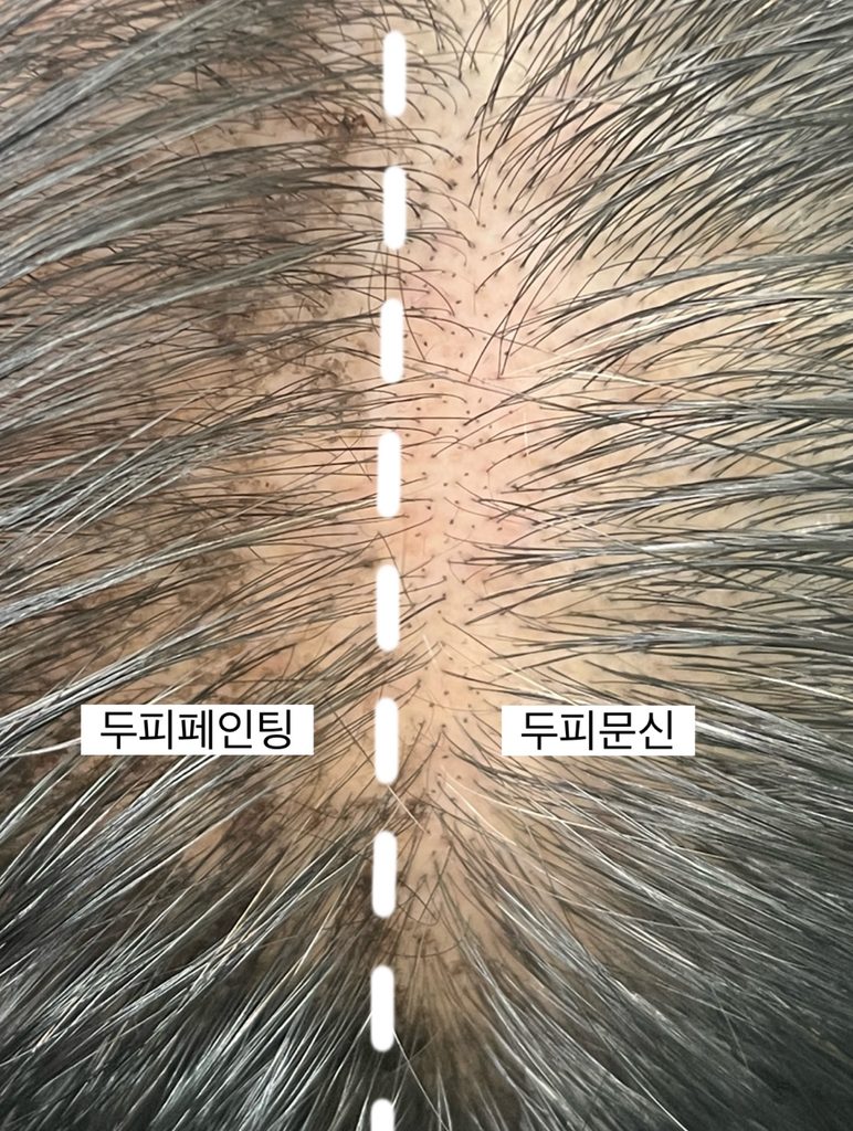 한 사람의 정수리를 반으로 나눠 비교한 근접 사진, 왼쪽은 두피페인팅 오른쪽은 모근처럼 점을 찍은 두피문신