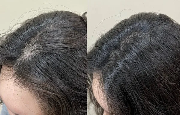 모발 방향대로 점을 찍는 장면