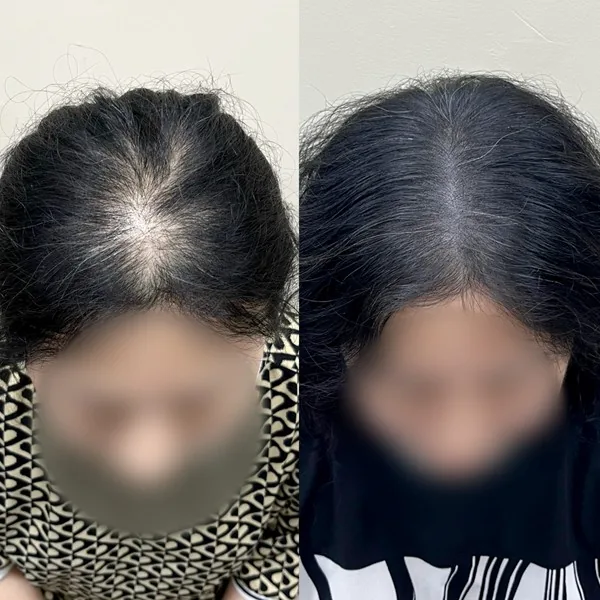 정수리 두피문신 전후 2