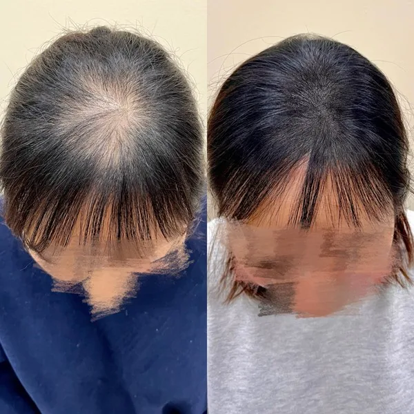 정수리 두피문신 전후 3