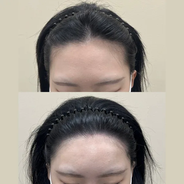헤어라인 두피문신 전후 1