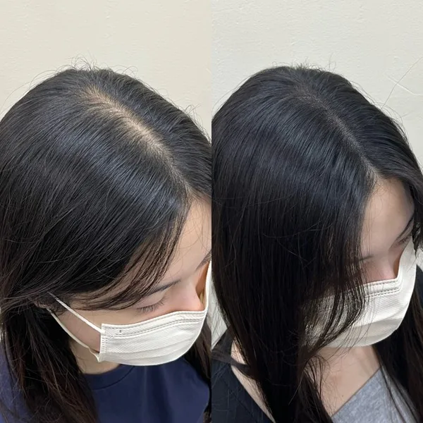 가르마 두피문신 전후 1
