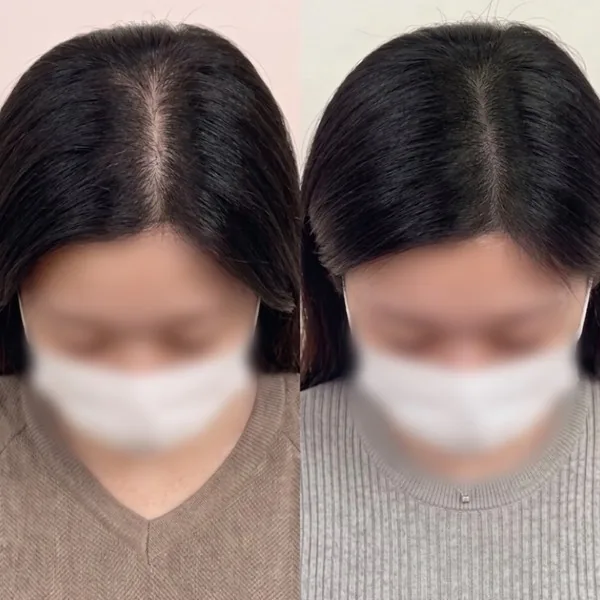가르마 두피문신 전후 2