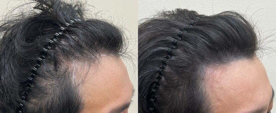 M자탈모 확인법, 원래 헤어라인과 탈모를 구분하는 기준
