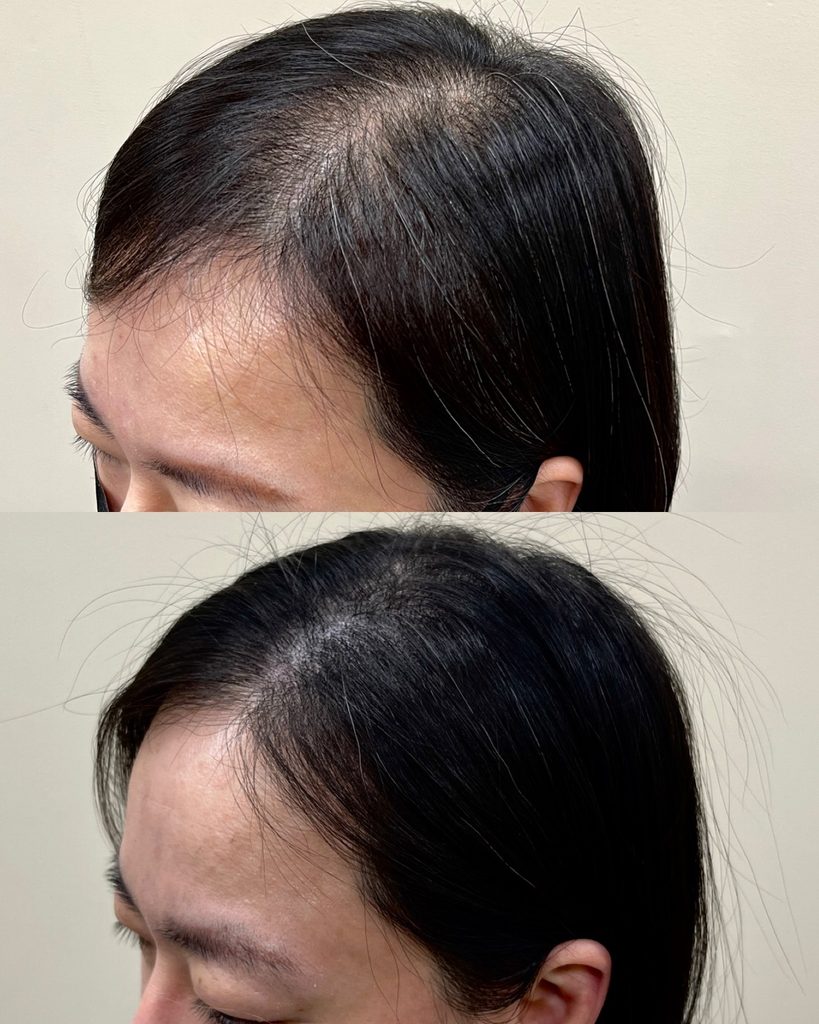 옆 헤어라인 두피문신 시술 전후 비교 - 비어 보이던 이마 옆 라인이 자연스럽게 채워진 모습