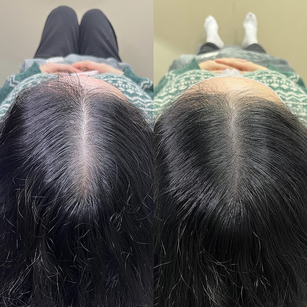 가르마·정수리 두피문신 시술 전후 비교 - 위에서 본 가르마 선의 두피 비침이 줄어든 모습