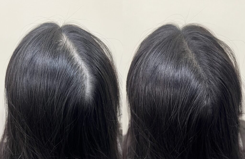 정수리 가르마 두피문신 시술 전후 비교 - 뒤에서 본 가르마의 두피 비침이 자연스럽게 줄어든 모습