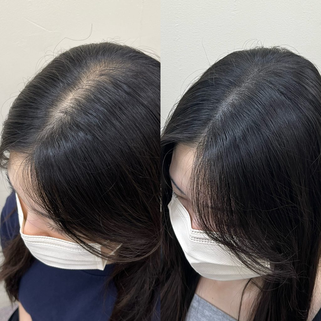 가르마 두피문신 시술 전후 비교 - 넓어 보이던 가르마의 두피 비침이 줄어든 모습