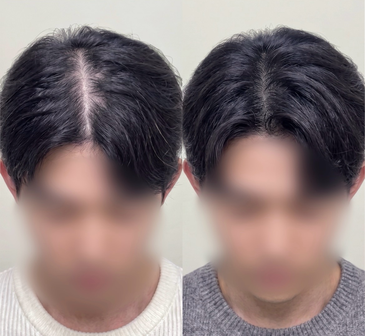 남성 가르마 두피문신 시술 전후 비교 — 가르마 주변 밀도가 채워진 모습