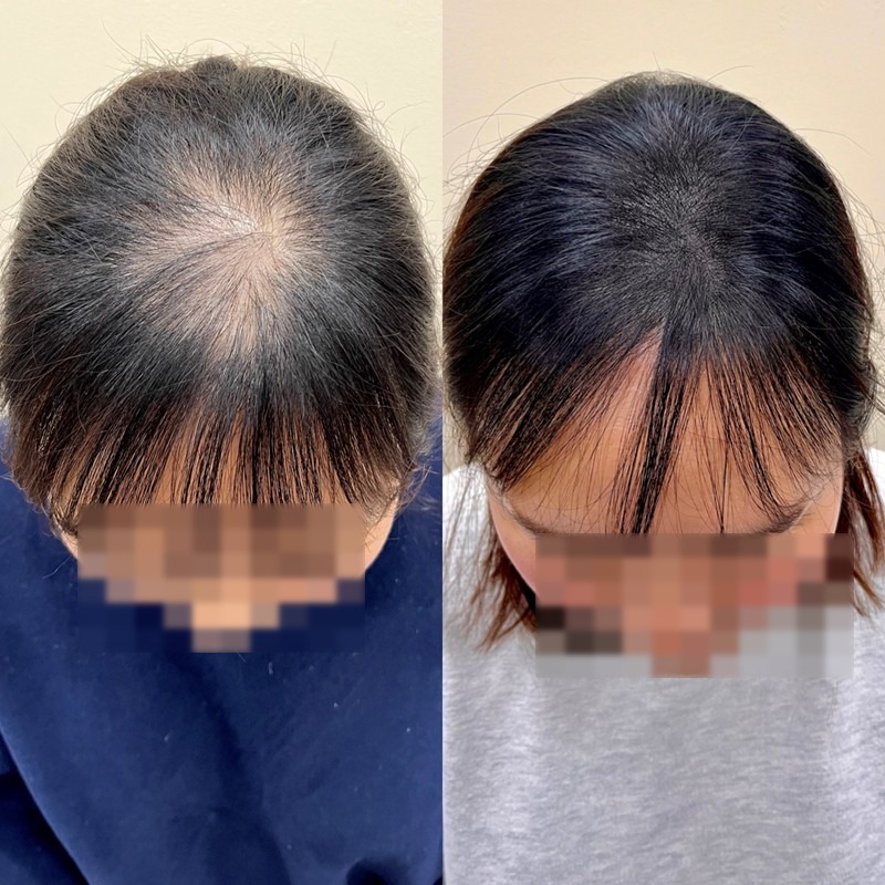 여성 정수리 두피문신 시술 전후 비교 — 정수리 빈 부위 밀도가 보강된 모습