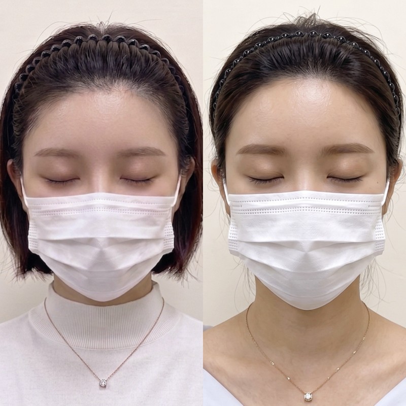 여성 헤어라인 두피문신 시술 전후 비교 — 이마 라인 밀도가 채워진 모습