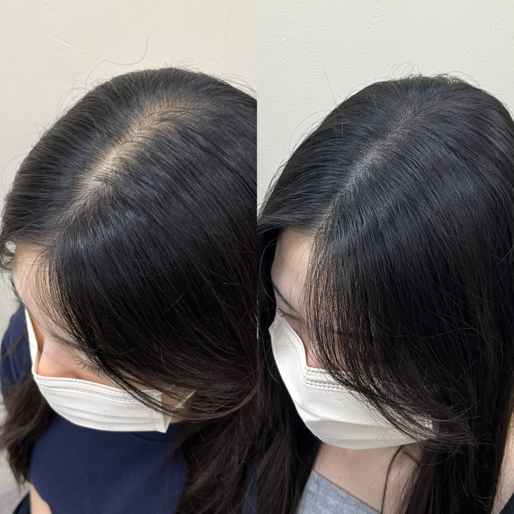 여성 가르마 두피문신 시술 전후 비교 — 가르마 갈라짐이 채워진 모습
