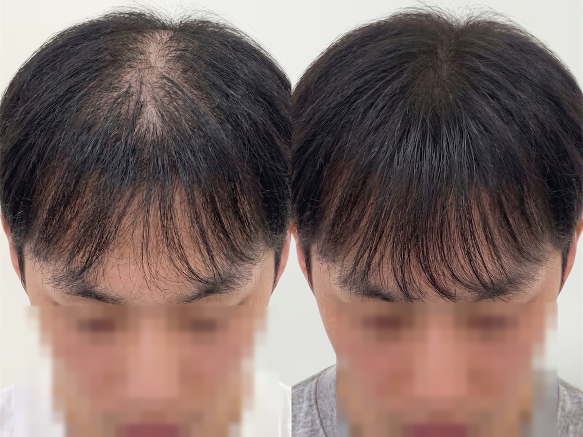 남성 정수리 두피문신 비포애프터