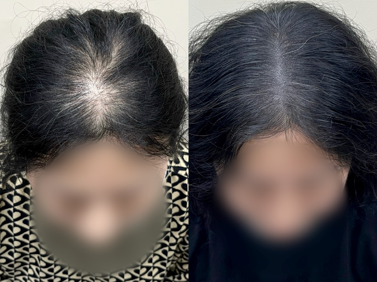 여성 정수리 두피문신 비포애프터