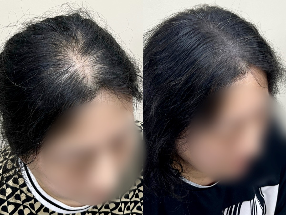 여성 정수리 두피문신 비포애프터