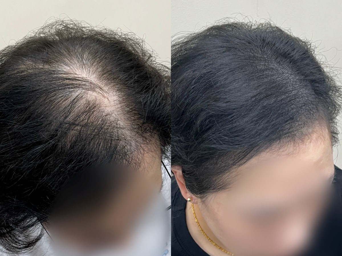 여성 정수리 두피문신 비포애프터