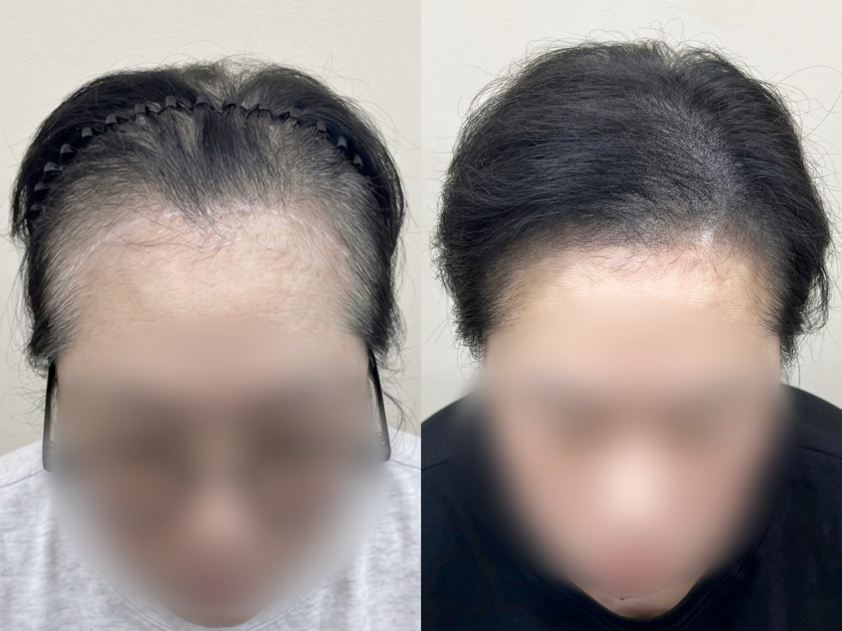 여성 헤어라인 두피문신 비포애프터
