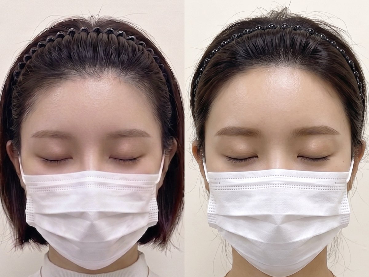 헤어라인 두피문신 시술 전후 비교 - 넓어 보이던 이마선이 자연스럽게 채워진 모습
