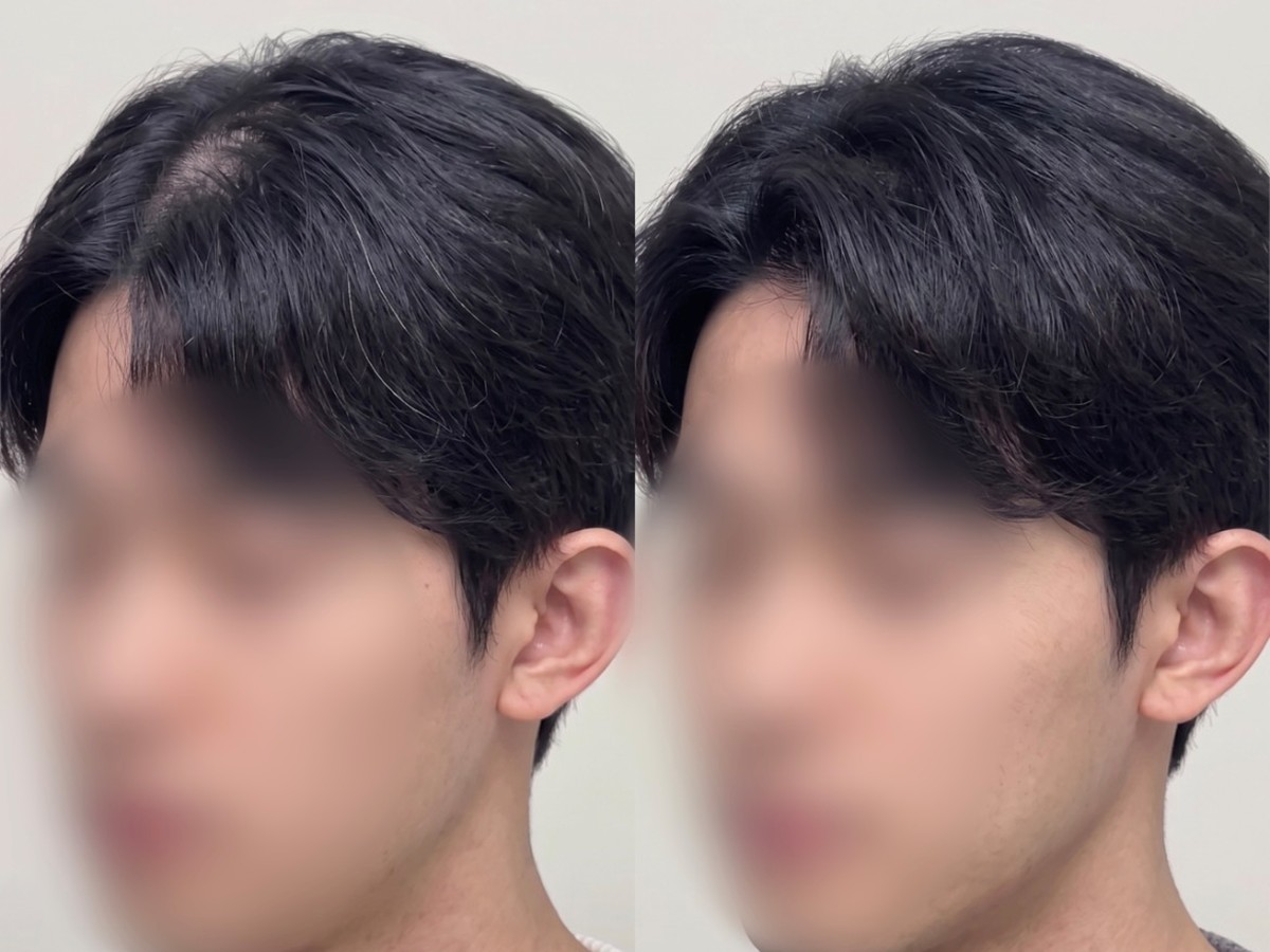 남성 가르마 두피문신 비포애프터