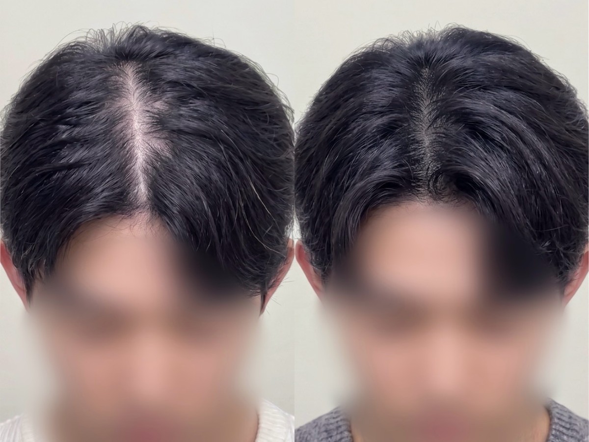 남성 가르마 두피문신 비포애프터