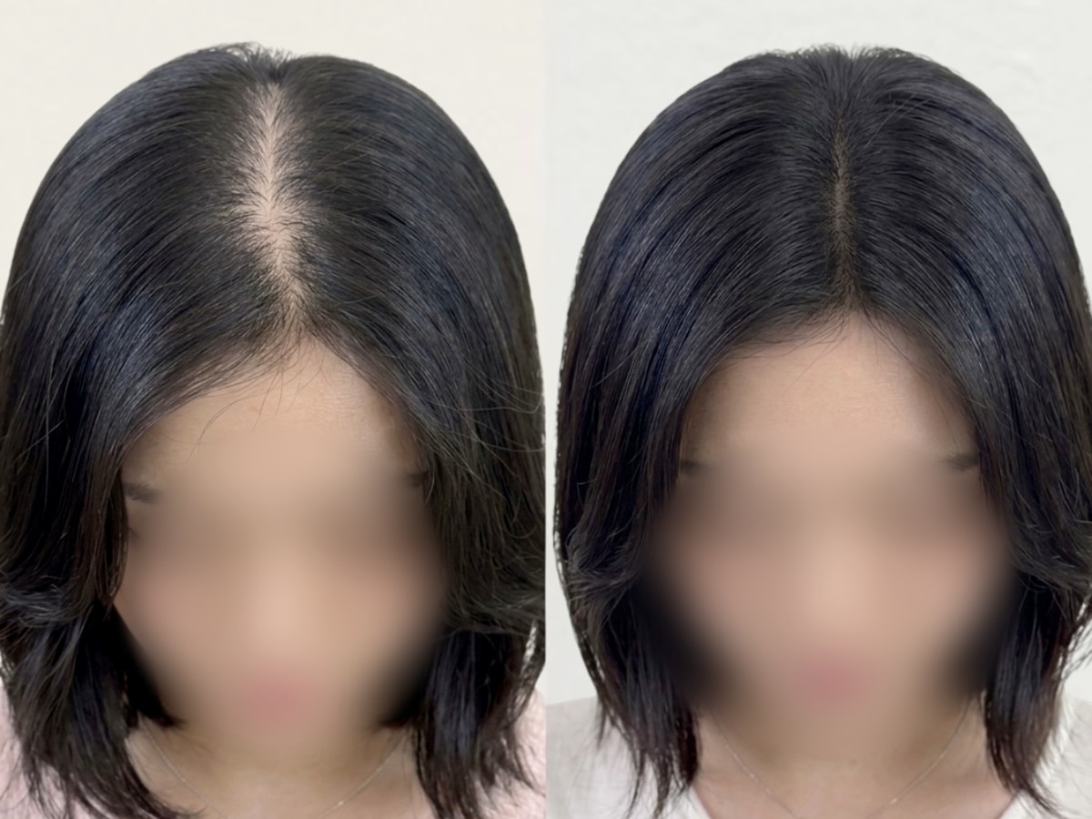 여성 가르마 두피문신 비포애프터