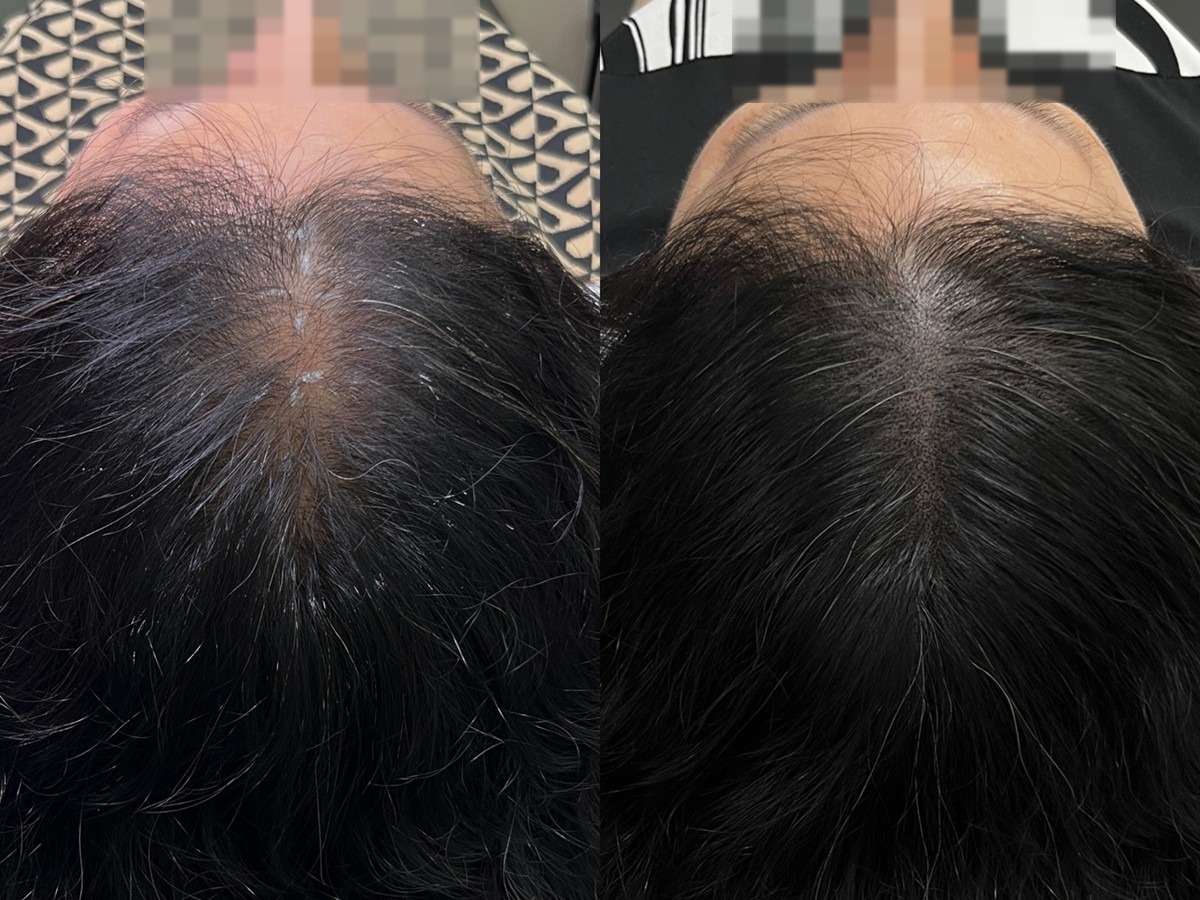 여성 가르마 두피문신 비포애프터